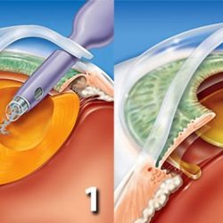 Cirurgia de Catarata