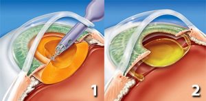 Cirurgia de Catarata