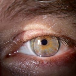adaptação de lentes de contato