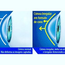ceratocone