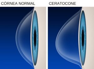 Tratamento do Ceratocone