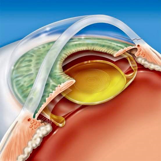 Cirurgia para Corrigir a Presbiopia