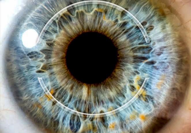 Tratamento de Ceratocone - Anel Intracorneano